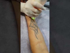 La valigia portatile K11 Q-ha commutato la macchina di rimozione del tatuaggio del laser di Yag