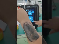Dispositivo per la rimozione dei tatuaggi laser a picosecondi laser Nd Yag P9