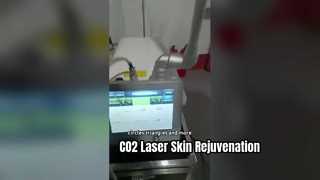 30W RF Tube Fractional Co2 laser per la rimozione delle cicatrici e il rafforzamento della pelle