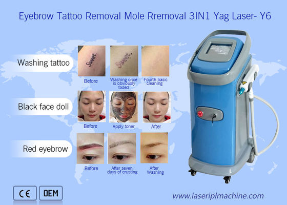 Buon prezzo 1064nm 532nm Nd Yag Laser Tattoo Removal Machine Dermatologia in linea